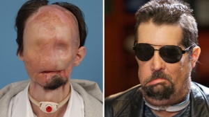 Ärzte schenken Mann neues Gesicht Ärzte haben Dallas Wiens ein komplettes Gesicht transplantiert.