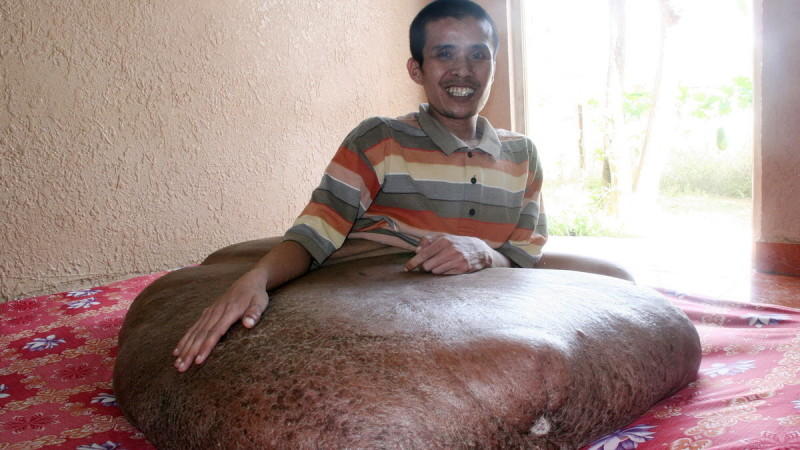 Ärzte entfernen Extrem-Tumor komplett Extrem-Tumor entfernt in Vietnam