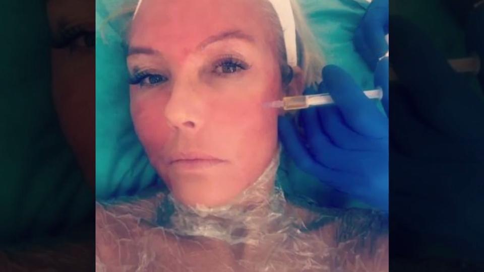 Blutige Beauty-Behandlung Vampir-Lifting für Natascha Ochsenknecht