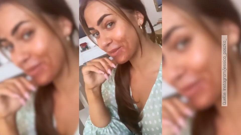 Ex-Bachelorette sieht schlimm aus Jessica Paszka leidet nach chemischem Peeling