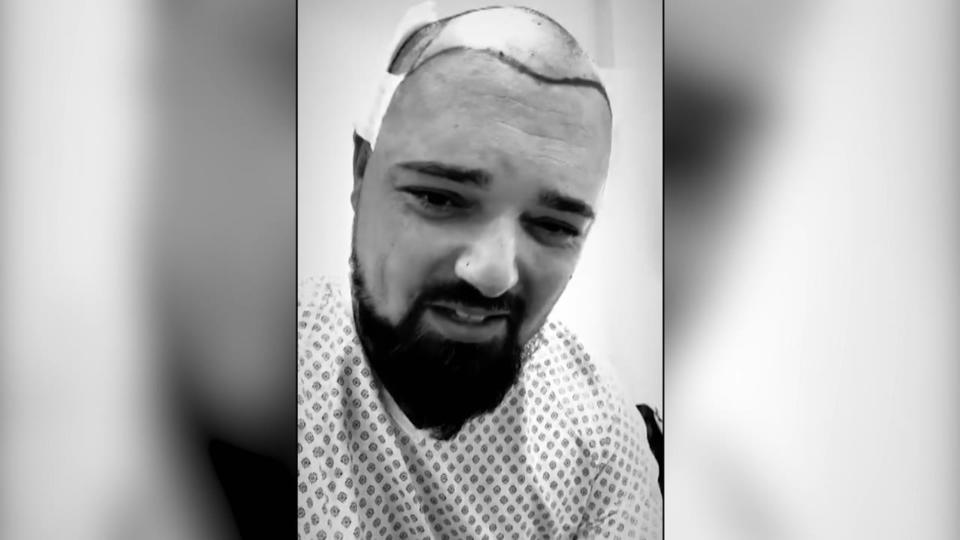 Haartransplantation Nik Schröder feiert seine "neuen" Haare