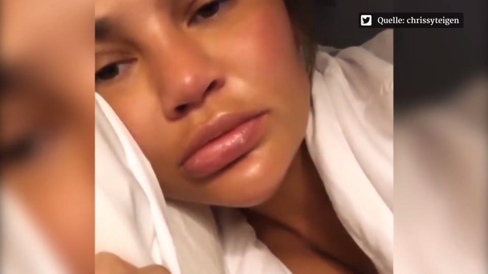 Dicke-Lippe-Alarm Chrissy Teigen teilt Schockbilder im Netz
