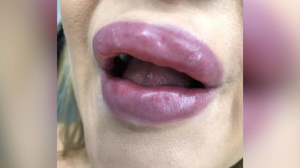 Prozess: Falsche Heilpraktikerin spritzte Lippen auf