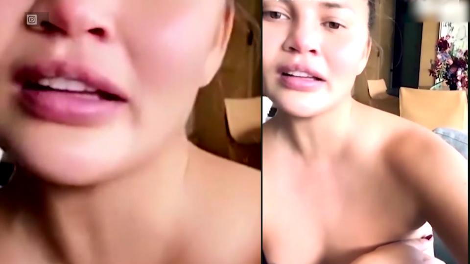 Chrissy Teigen hat die Brust-Implantate raus Chrissy Teigen zeigt ihre Brust nach der OP