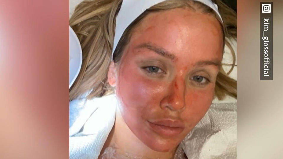 Achtung, es wird blutig! Kim Gloss beim Vampir-Lifting