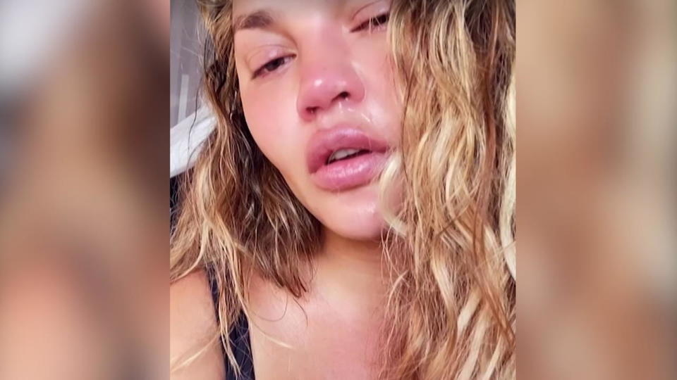 Verheult nach der Therapie Chrissy Teigen trauert um ihr verlorenes Kind
