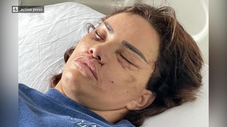 Nach Horror-Schock-Foto Katie Price zeigt ihr "neues" Gesicht nach OP