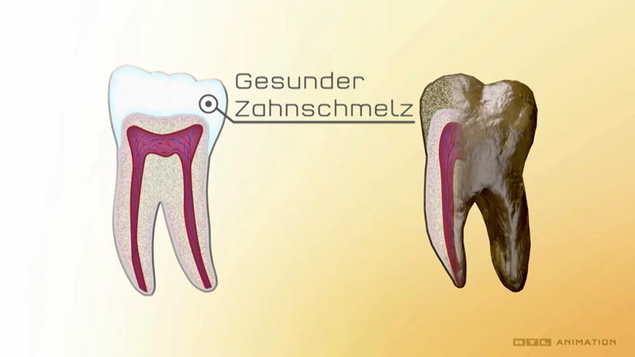 Ein gesunder Zahn im Gegensatz zu einem porösen Zahn.