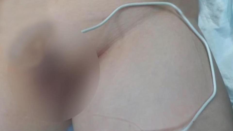 Junge mit Kabel in Penis.