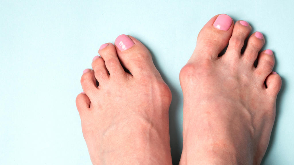 Ballenzeh Hallux Valgus