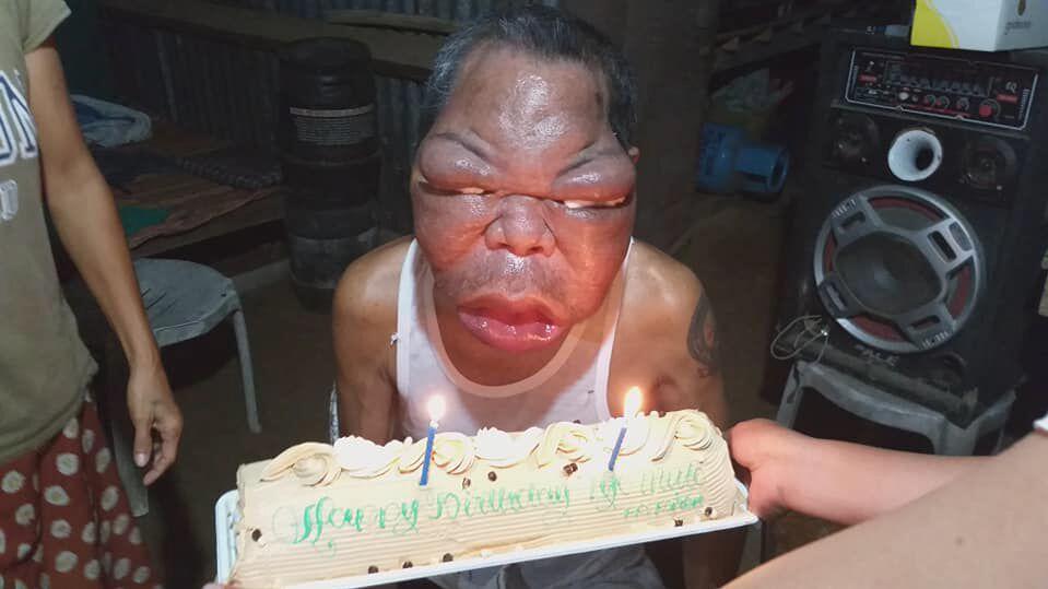 Philippinen Mann Hat Extrem Geschwollenes Gesicht Welche Krankheit Steckt Dahinter