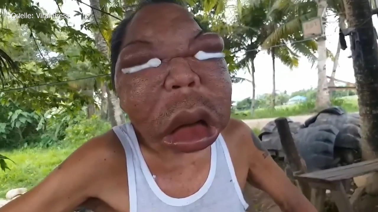 Philippinen Mann Hat Extrem Geschwollenes Gesicht Welche Krankheit Steckt Dahinter