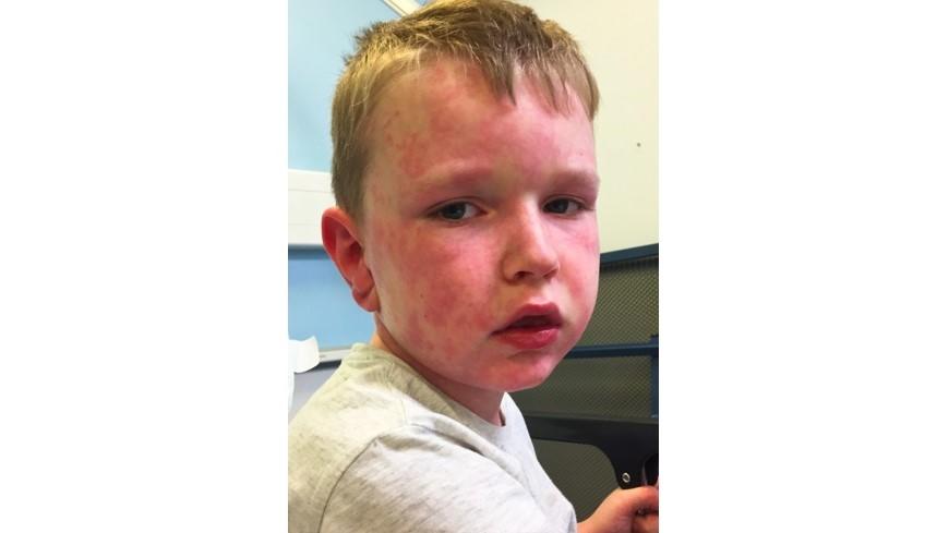 Ein Dermatologe diagnostizierte bei Tommy im Alter von 5 Jahren ein Kälte-Urtikaria und Angioödem.