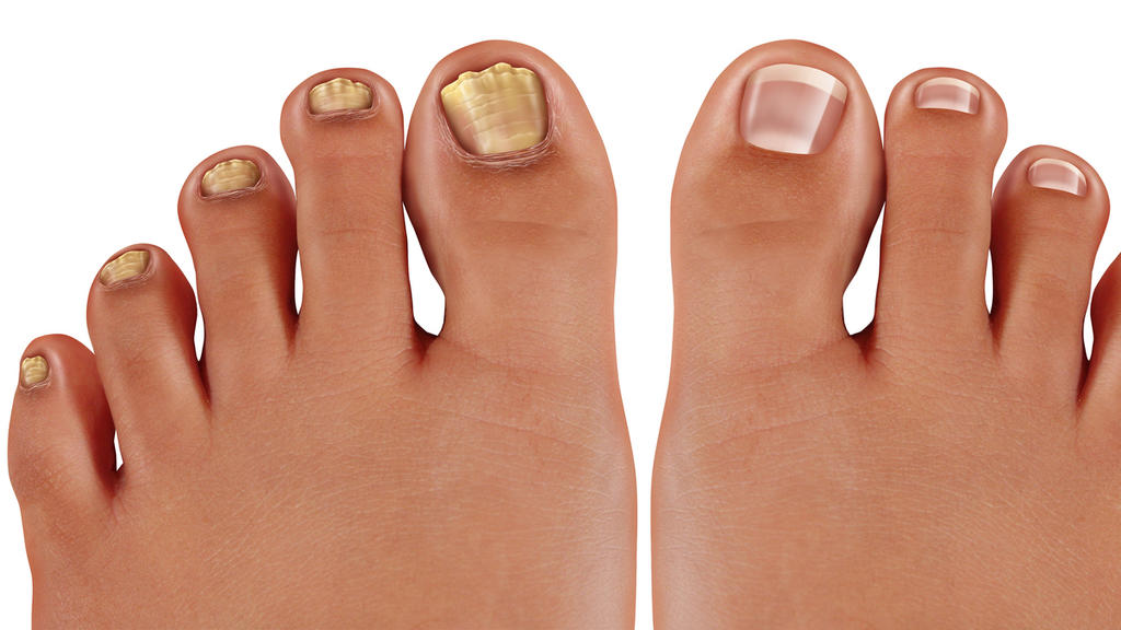 Anzeichen für Nagelpilz