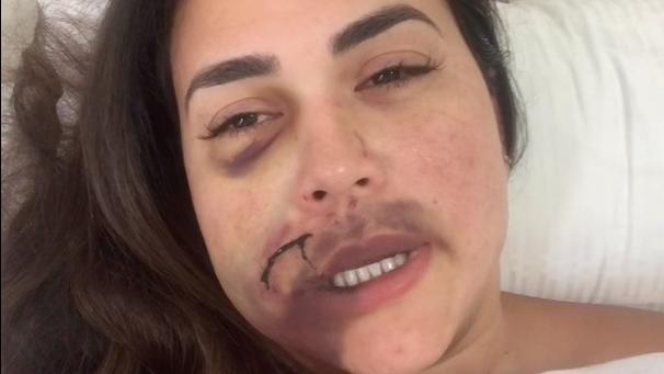 Das Gesicht von Milka Borges ist nach dem Glaswurf entstellt