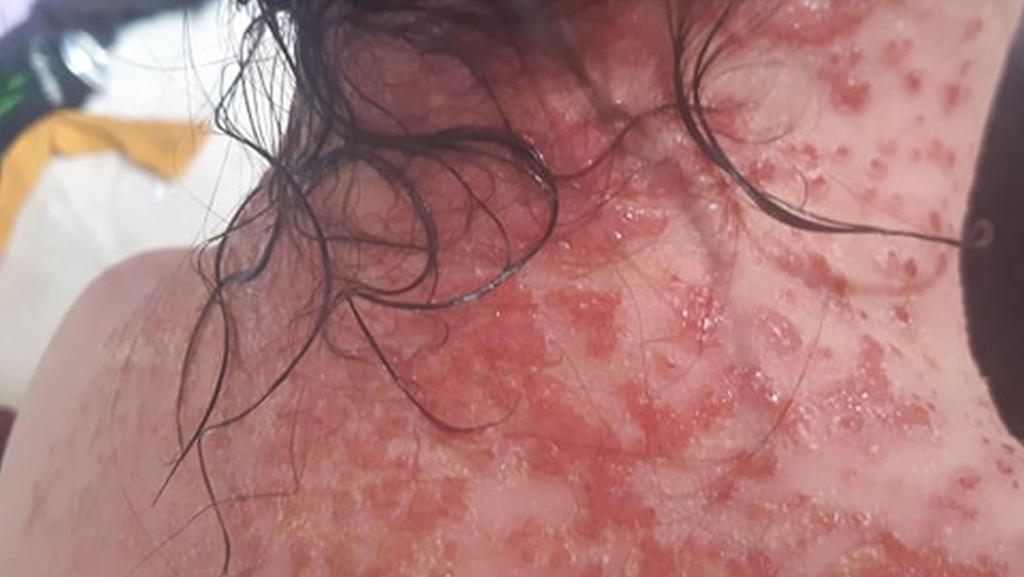 Horror-Bilder: Der schmerzhafte Ausschlag zog sich ihren kompletten Nacken entlang