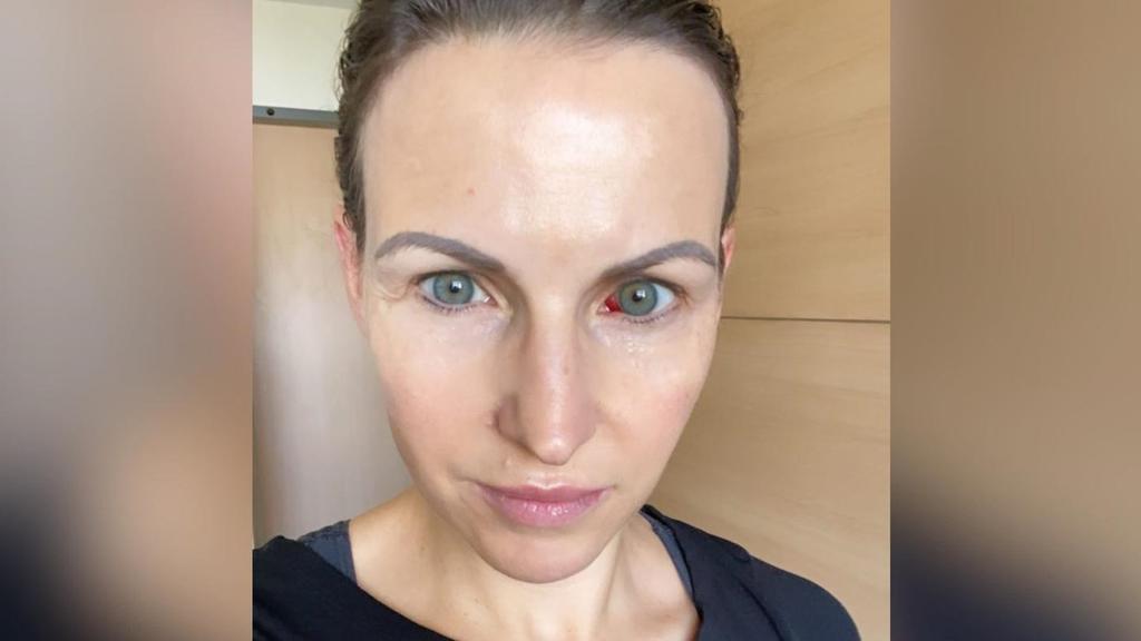 Sabrina Mockenhaupt postet ein Foto aus dem Krankenhaus, was sie mit einer Verletzung am Auge zeigt.