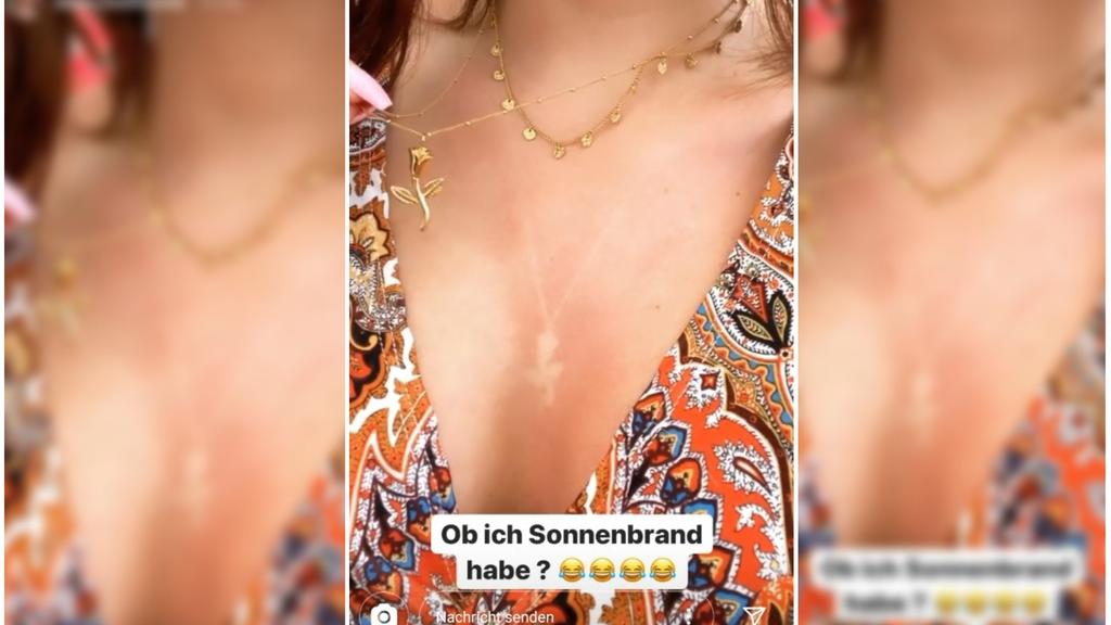 Jenny Frankhauser zeigt ihren Sonnenbrand