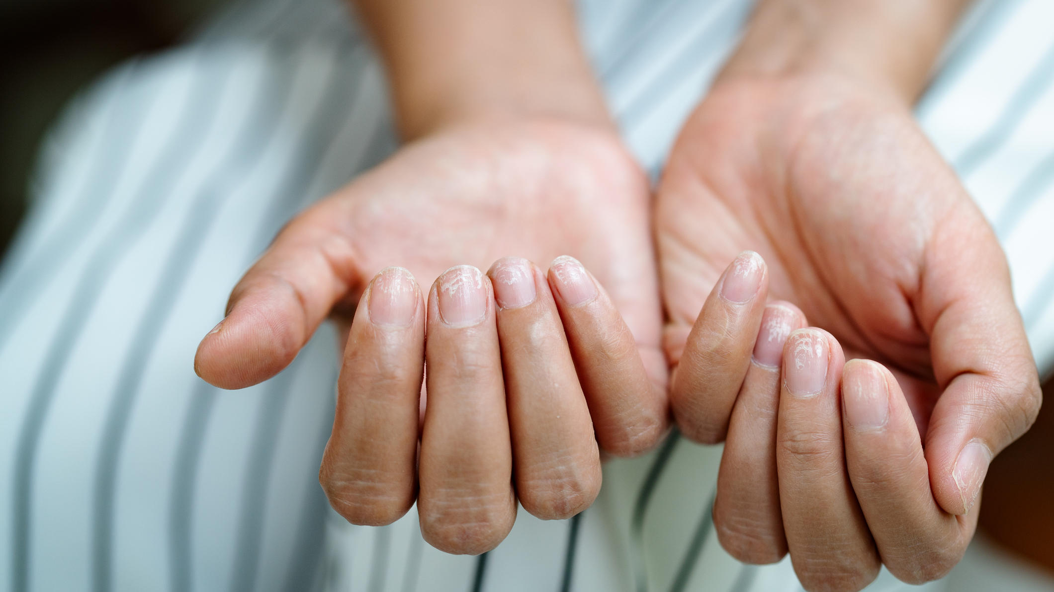 Lungenkrebs An Veranderten Fingernageln Erkennen Diese Nagelform Kann Ein Hinweis Sein