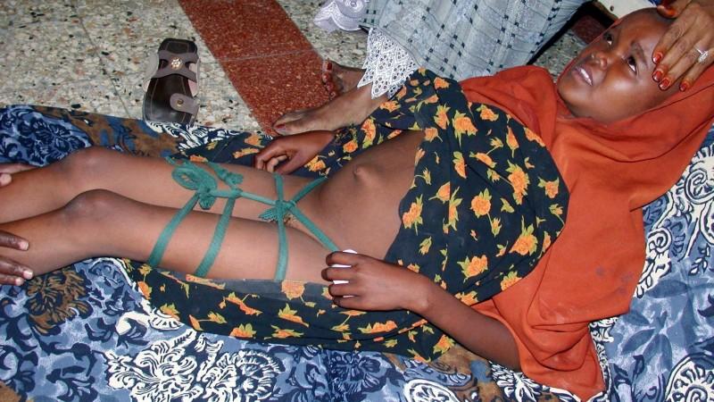 Beschnitten vagina Weibliche Genitalverstümmelung