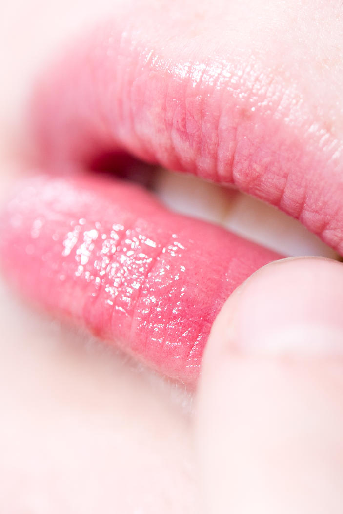Eingerissene Mundwinkel Oft Ist Vitaminmangel Die Ursache