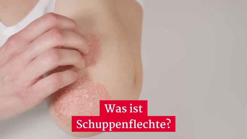 Partnersuche psoriasis